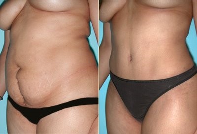 abdominoplastie avant après