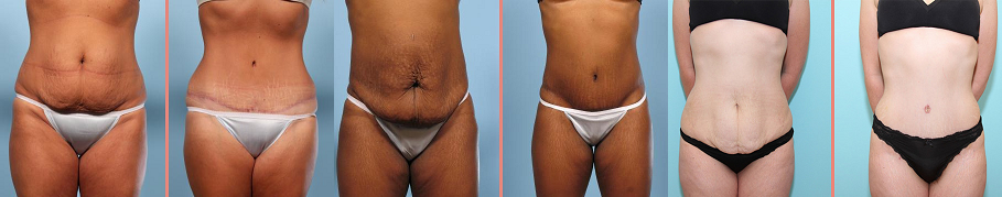 photo abdominoplastie avant apres