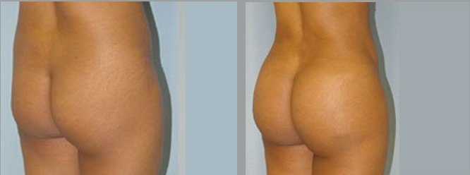 augmentation fesses avant après