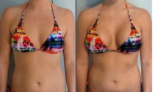 augmentation seisn avant après