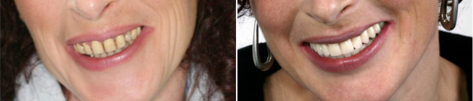 blanchiment dentaire avant après