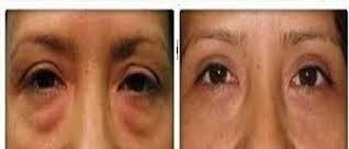 ablepharoplastie vant après