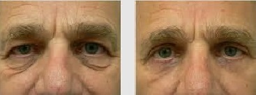 photo avant apres chirurgie paupieres en tunisie