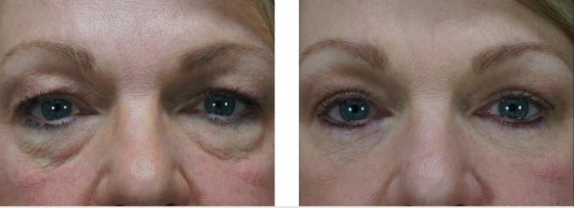 blepharoplastie laser tunisie