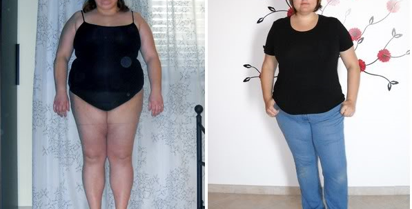 chirurgie obésité avant après