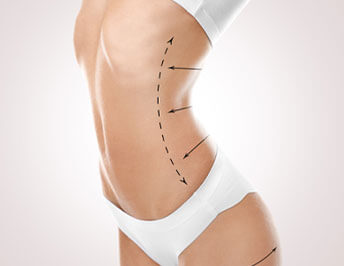 chirurgie esthetique silhouette en Tunisie : chirurgie silhouette