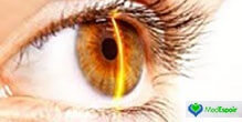 chirurgie yeux medespoir