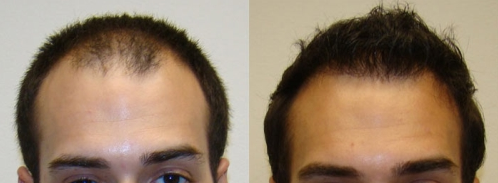 greffe cheveux avant après