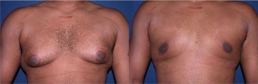 gynécomastie avant après