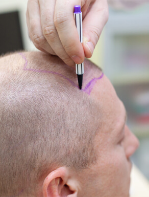 greffe cheveux tunisie