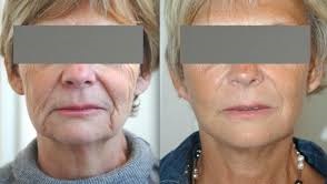 prix lifting visage medespoir 