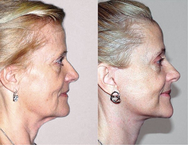 lifting avant après