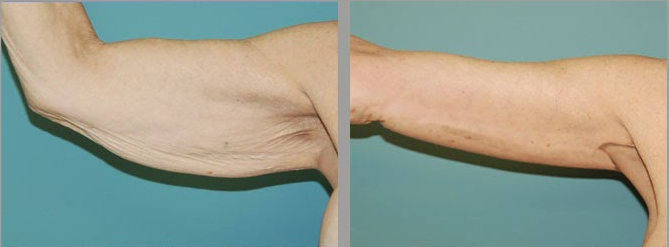 lifting bras avant après