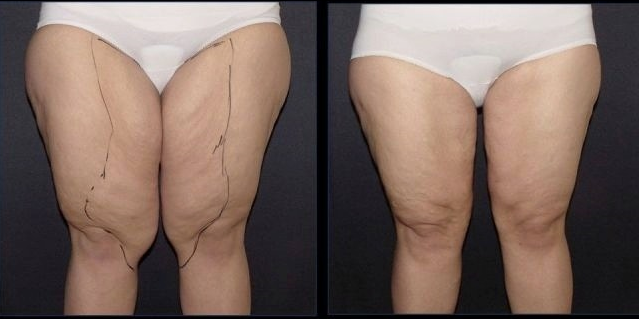 lifting cuisses avant après