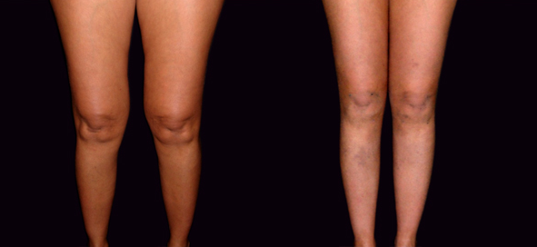 lifting genoux avant après