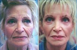 lifting visage prix medespoir