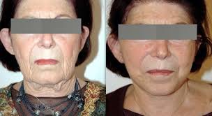 lifting visage medespoir avant après