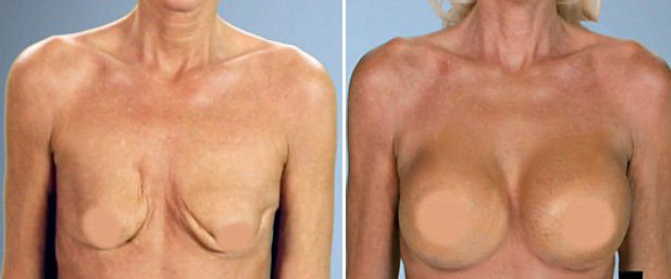 lipofilling seins avant après