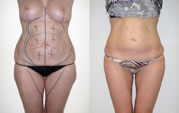 liposuccion avant après