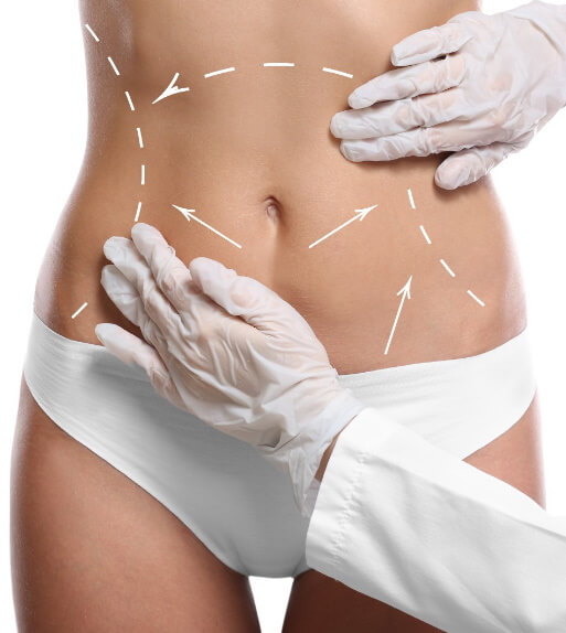 liposuccion