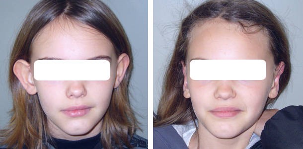 otoplastie avant après