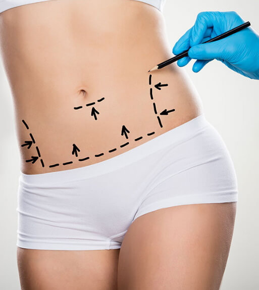 abdominoplastie cicatrice