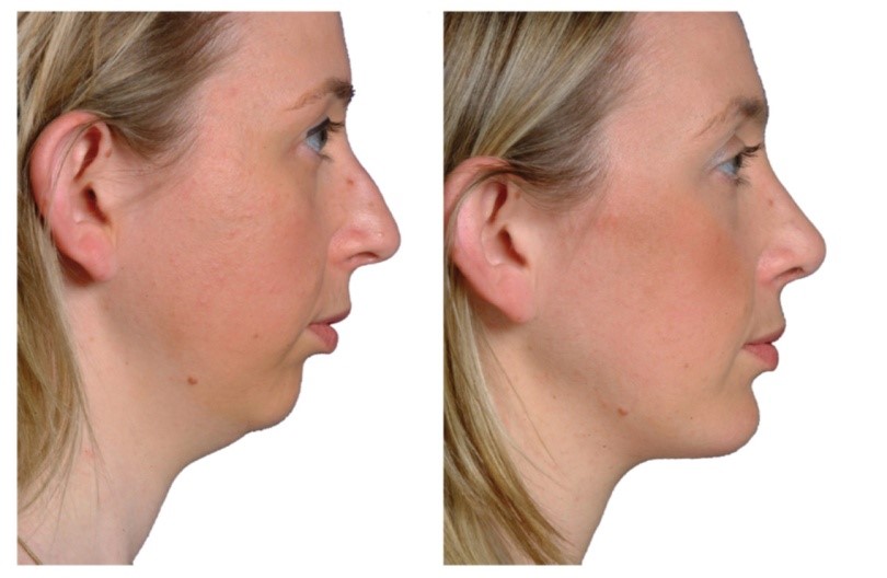 profiloplastie avant après