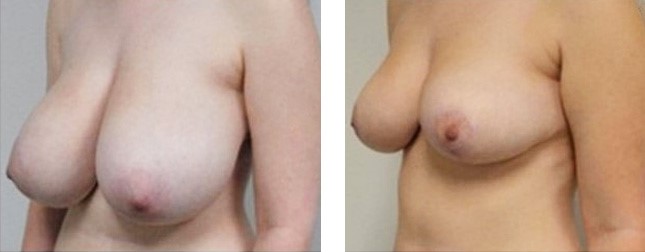reduction seins avant après