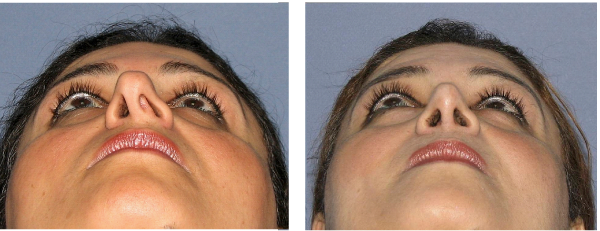 resultat chirurgie septale Tunisie : photo avant après