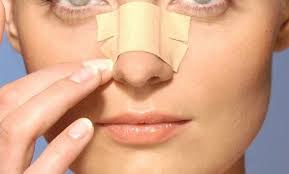 fracture du nez