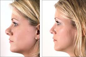 rhinoplastie pour corriger fracture de nez