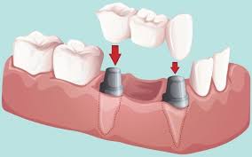 bridge dentaire