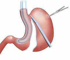 types de sleeve gastrique
