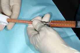 lipofilling