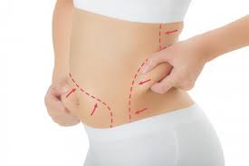 lipoaspiration de graisse