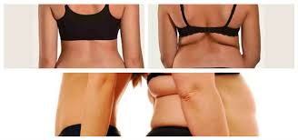 resultat liposuccion