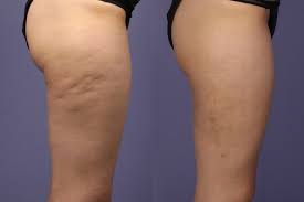 supprimer cellulite
