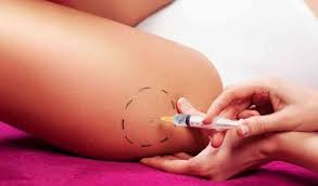 éliminer cellulite par injection dioxyde de carbon