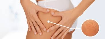traitement cellulite par carboxythérapie