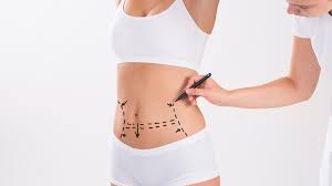 stars ayant subi abdominoplastie