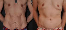 chirurgie bodylift