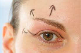 lifting de sourcils