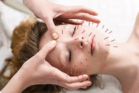 technique d'acupuncture