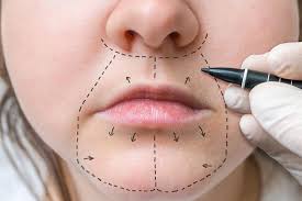 acide hyaluronique lèvres