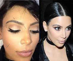 kim kardishian acupuncture