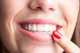 gingivectomie