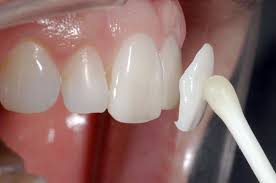 facette temporaire