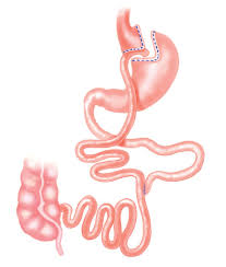 chirurgie obesite