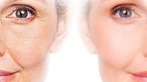 microneedling