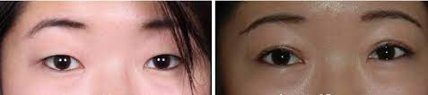 blepharoplastie asiatique avant après